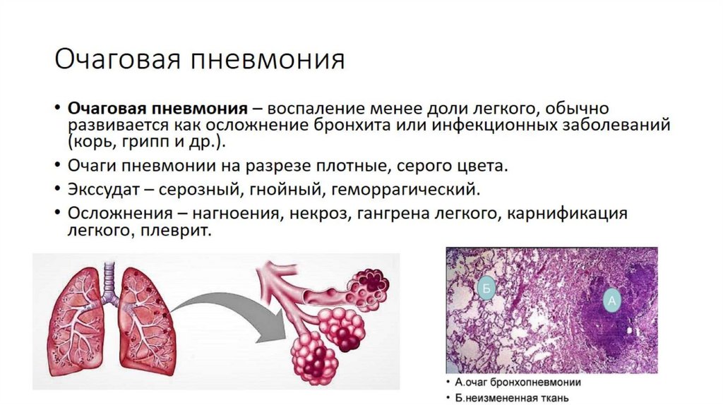 Очаговая пневмония