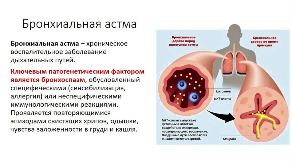 Бронхиальная астма