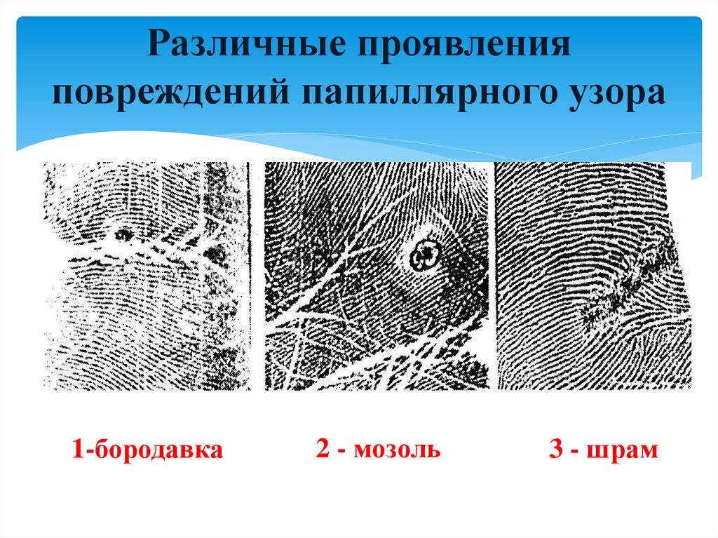 Различные проявления повреждений папиллярного узора