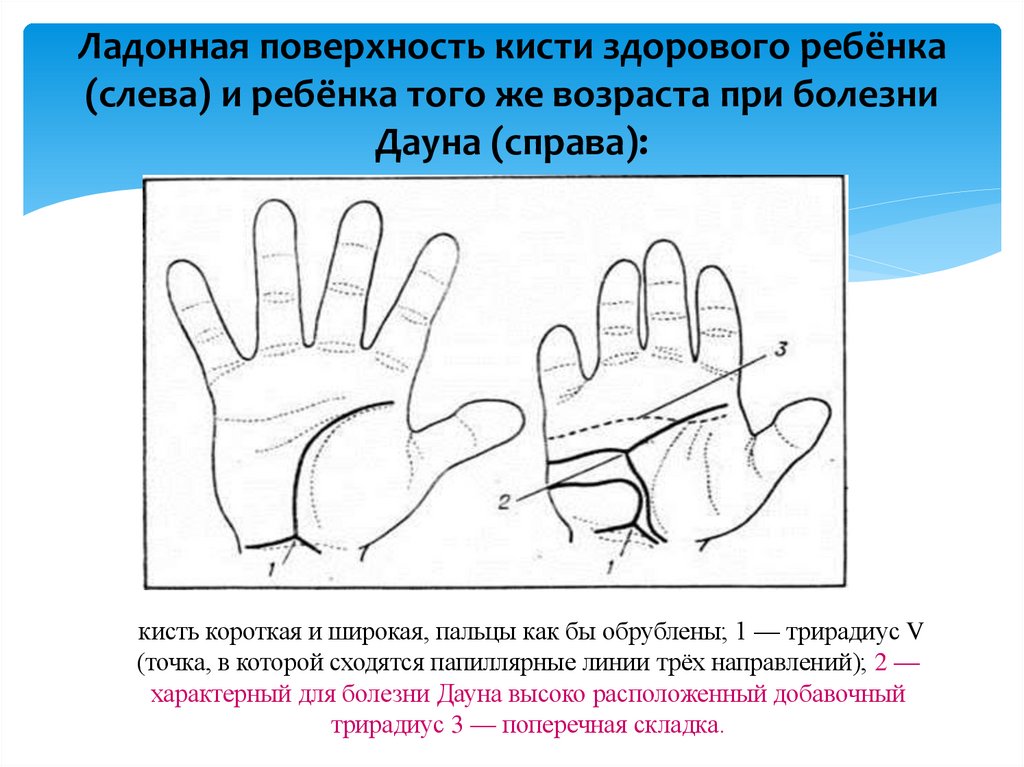 Ладонная поверхность кисти здорового ребёнка (слева) и ребёнка того же возраста при болезни Дауна (справа):