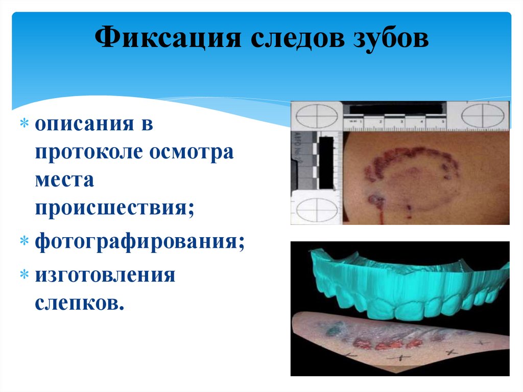 Фиксация следов зубов