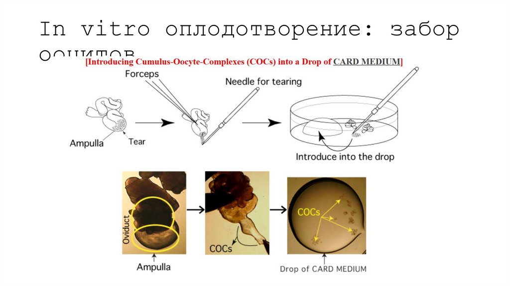 In vitro оплодотворение: забор ооцитов