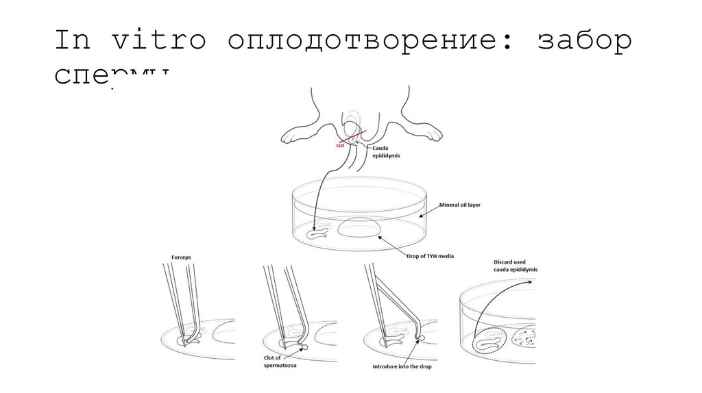 In vitro оплодотворение: забор спермы