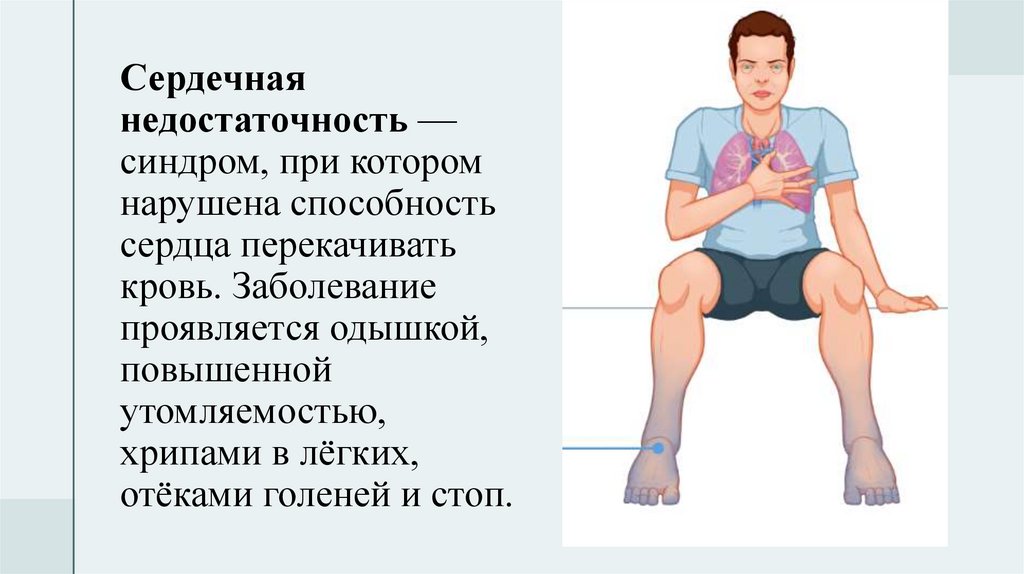 Сердечная недостаточность — синдром, при котором нарушена способность сердца перекачивать кровь. Заболевание проявляется