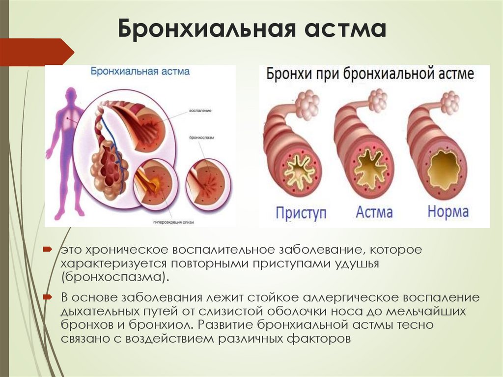 Бронхиальная астма