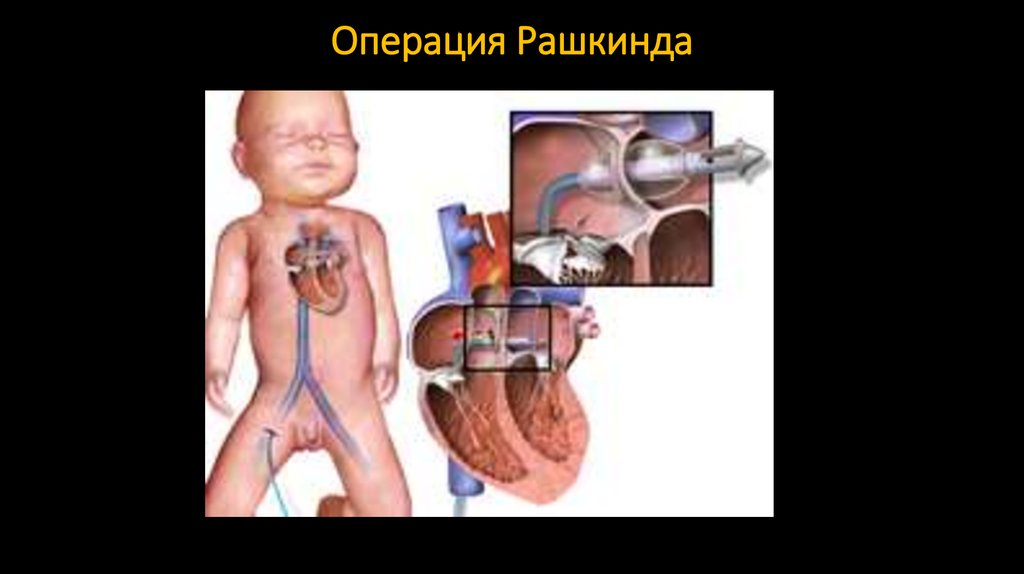 Операция Рашкинда