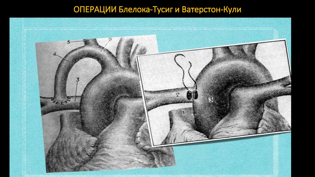 ОПЕРАЦИИ Блелока-Тусиг и Ватерстон-Кули