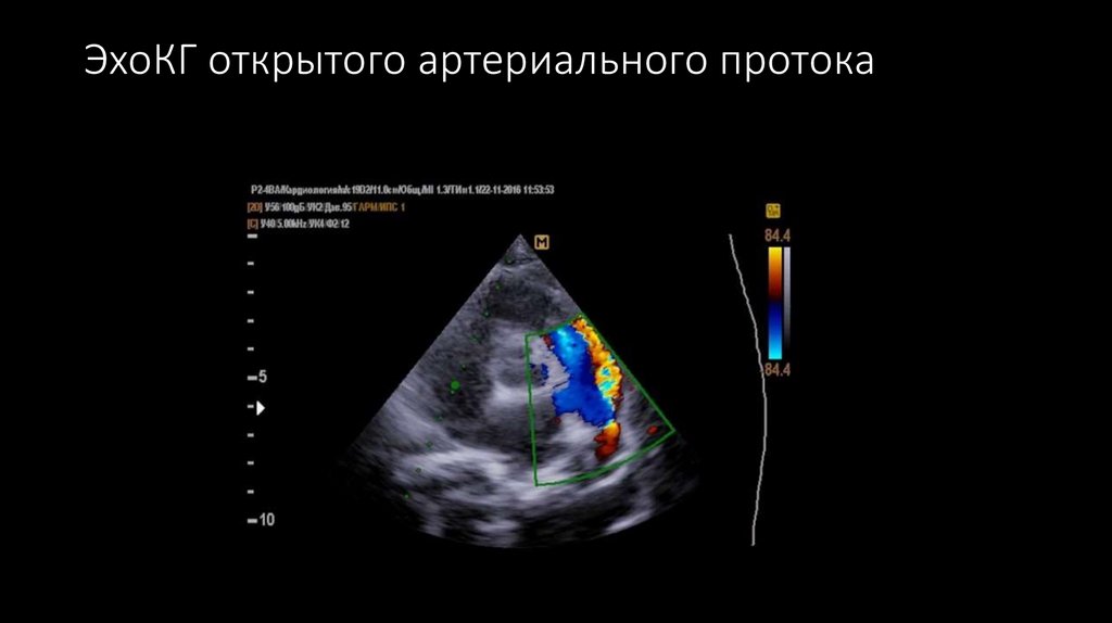 ЭхоКГ открытого артериального протока