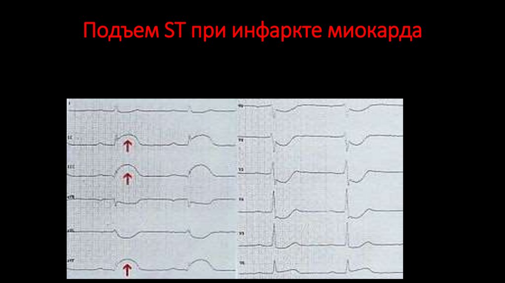 Подъем ST при инфаркте миокарда