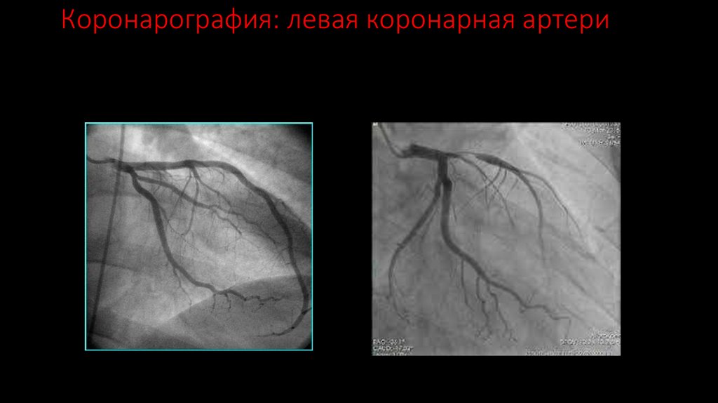 Коронарография: левая коронарная артери