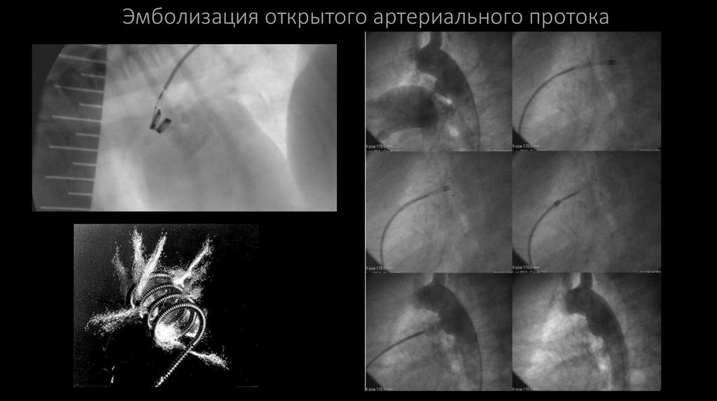 Эмболизация открытого артериального протока
