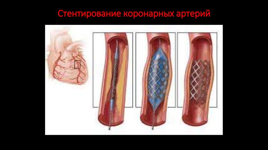 Стентирование коронарных артерий
