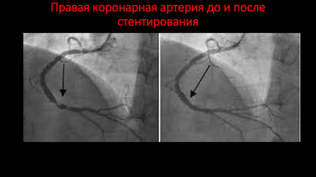 Правая коронарная артерия до и после стентирования