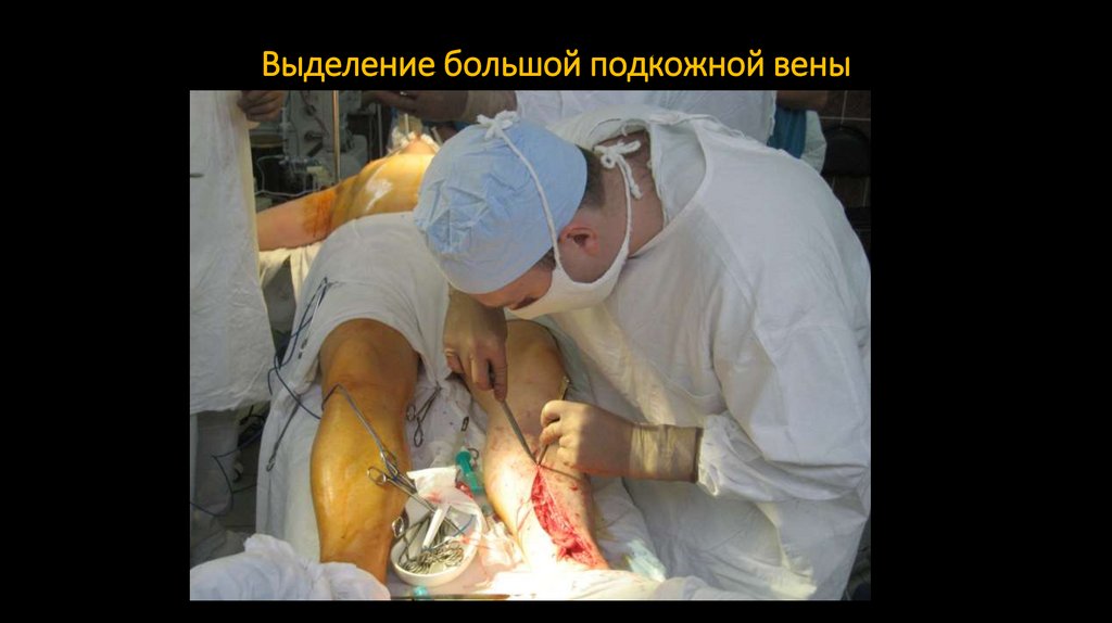 Выделение большой подкожной вены