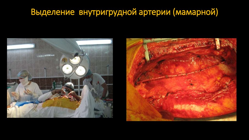 Выделение внутригрудной артерии (мамарной)