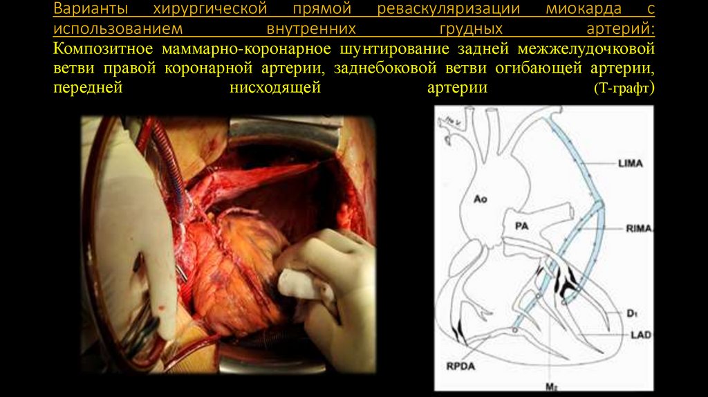 Варианты хирургической прямой реваскуляризации миокарда с использованием внутренних грудных артерий: Композитное