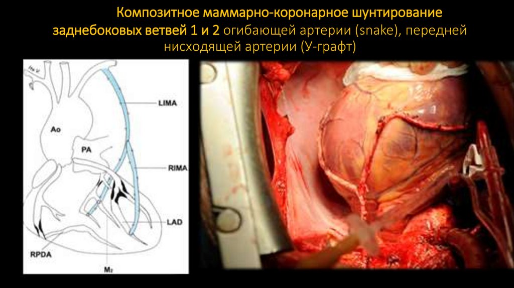Композитное маммарно-коронарное шунтирование заднебоковых ветвей 1 и 2 огибающей артерии (snake), передней нисходящей артерии