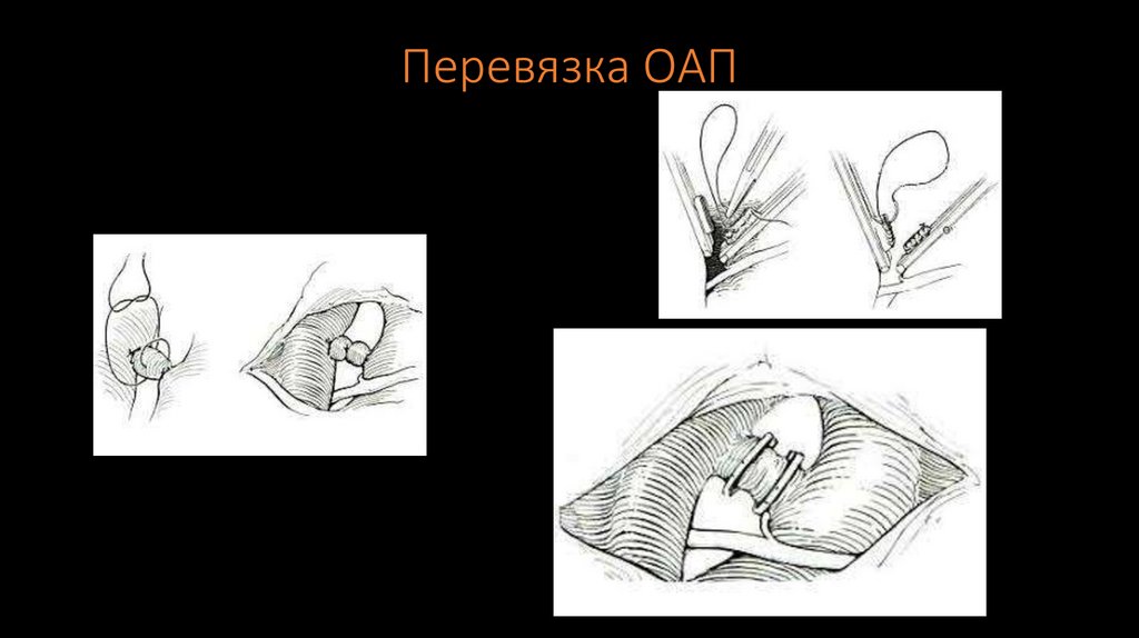 Перевязка ОАП