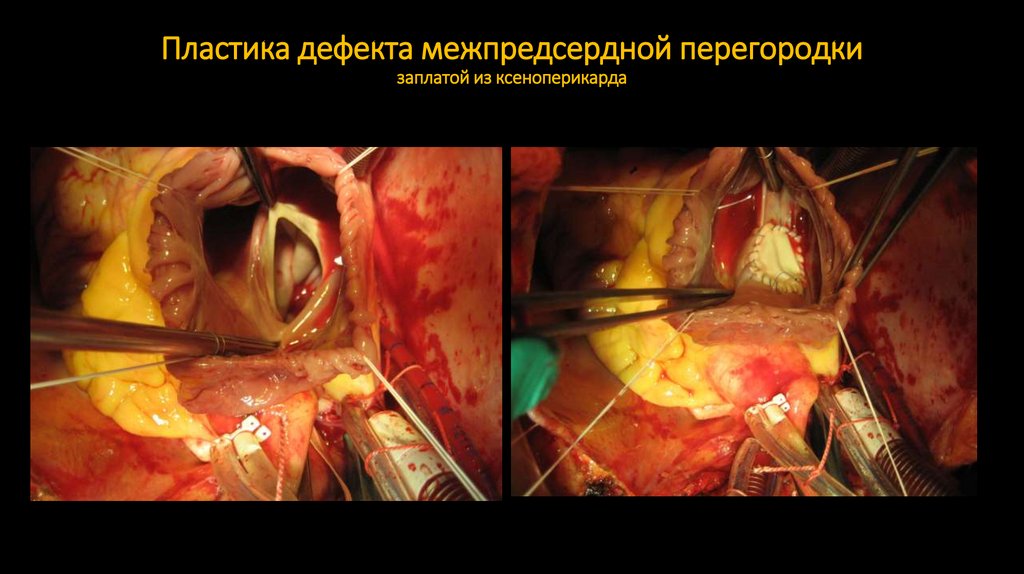 Пластика дефекта межпредсердной перегородки заплатой из ксеноперикарда