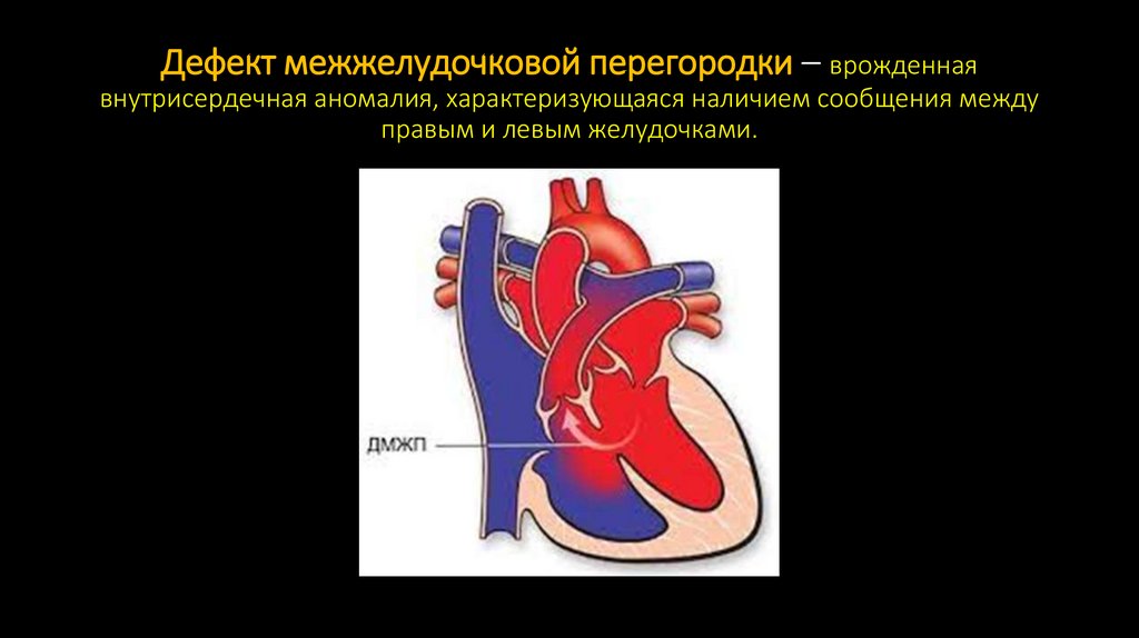 Дефект межжелудочковой перегородки – врожденная внутрисердечная аномалия, характеризующаяся наличием сообщения между правым и