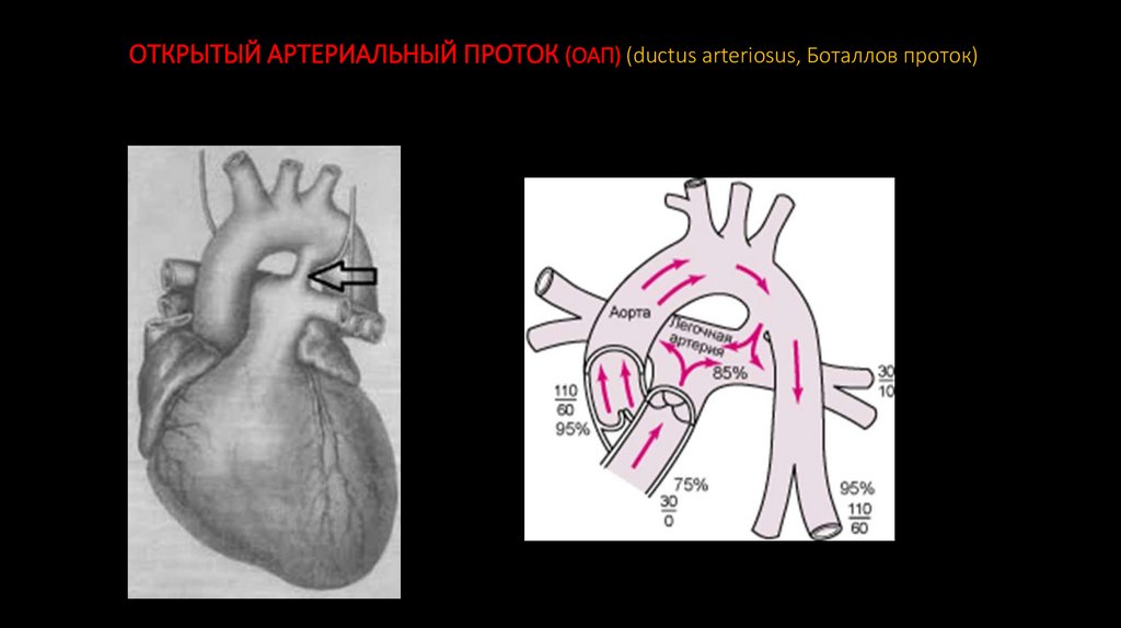ОТКРЫТЫЙ АРТЕРИАЛЬНЫЙ ПРОТОК (ОАП) (ductus arteriosus, Боталлов проток)