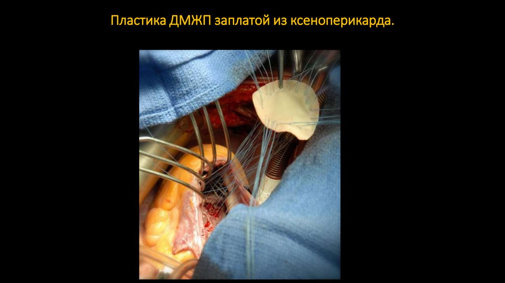 Пластика ДМЖП заплатой из ксеноперикарда.