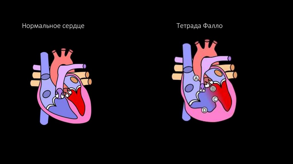 Нормальное сердце Тетрада Фалло
