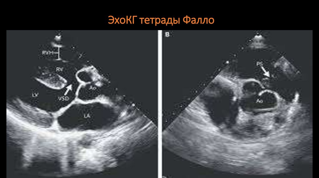 ЭхоКГ тетрады Фалло