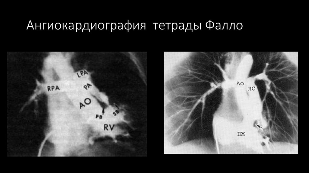Ангиокардиография тетрады Фалло