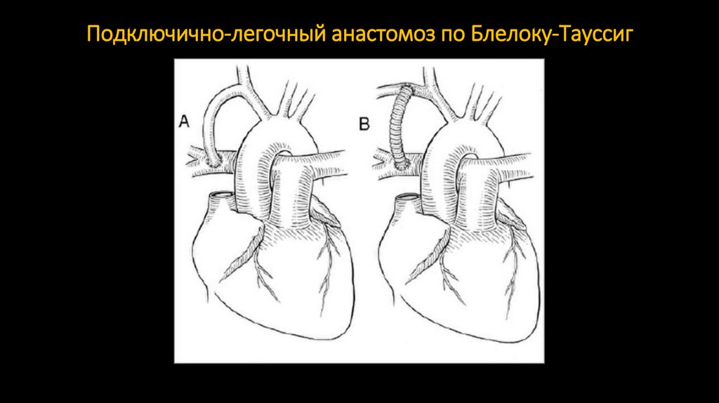 Подключично-легочный анастомоз по Блелоку-Тауссиг