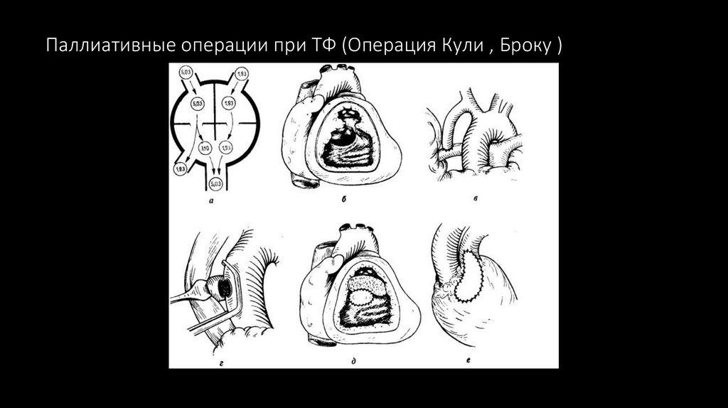 Паллиативные операции при ТФ (Операция Кули , Броку )