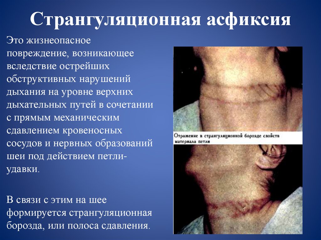 Странгуляционная асфиксия