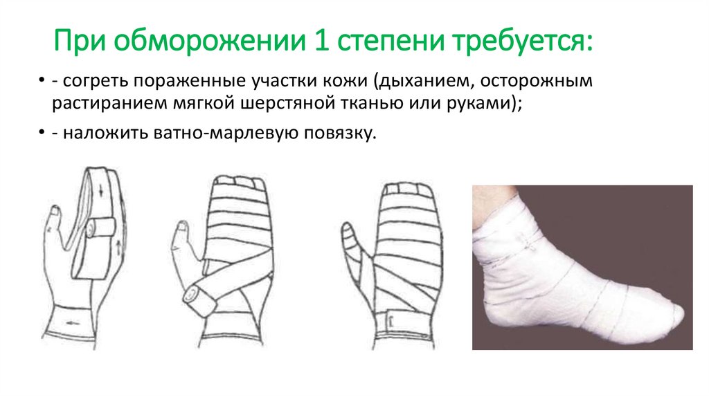 При обморожении 1 степени требуется: