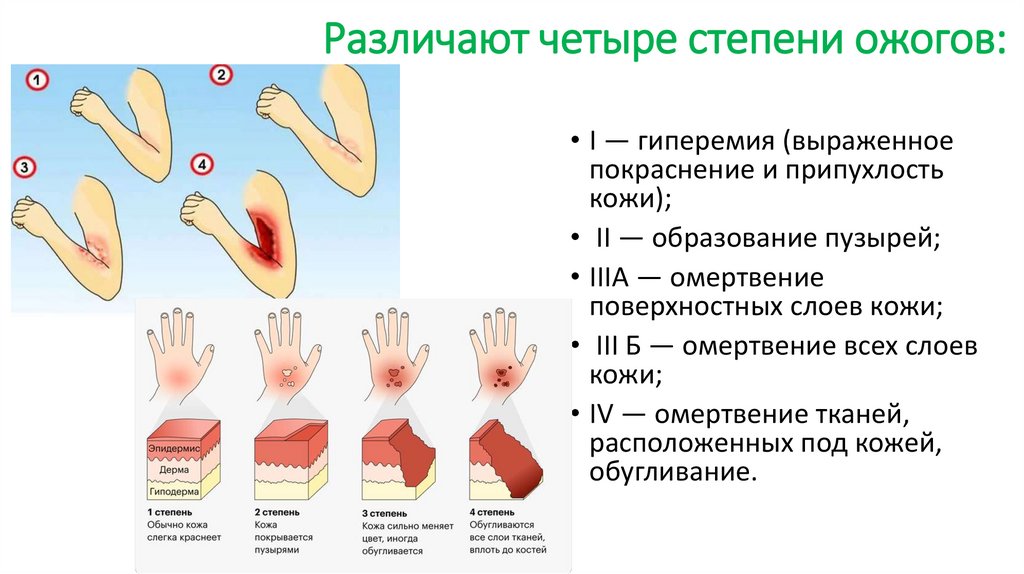 Различают четыре степени ожогов: