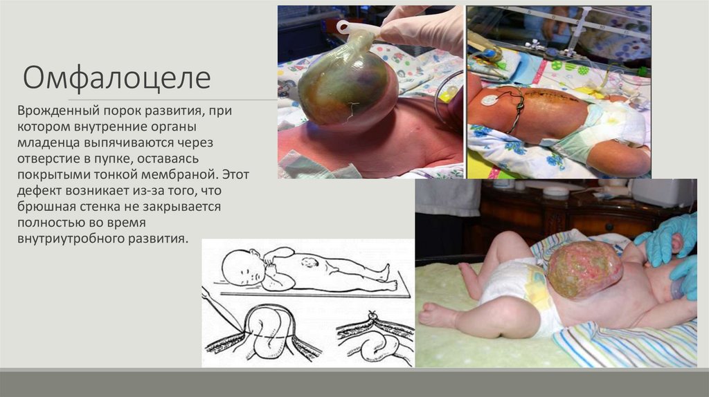 Омфалоцеле