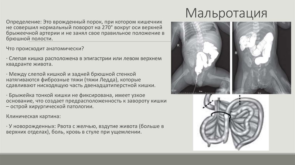 Мальротация