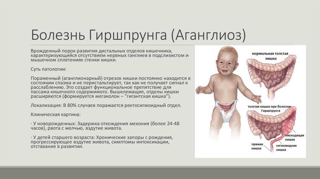 Болезнь Гиршпрунга (Аганглиоз)