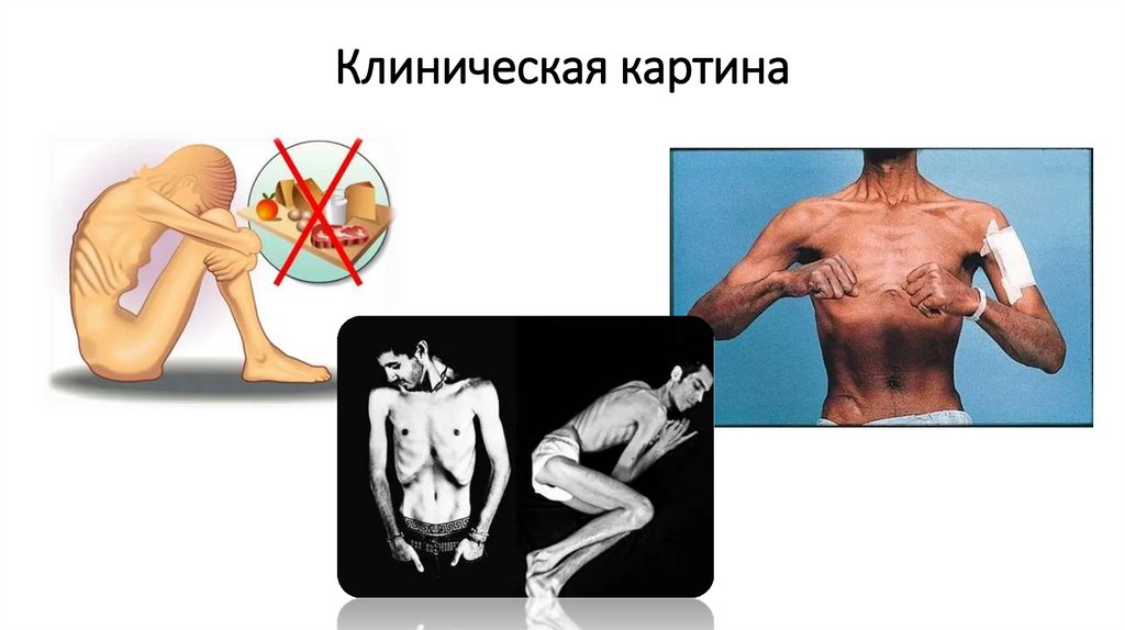 Клиническая картина