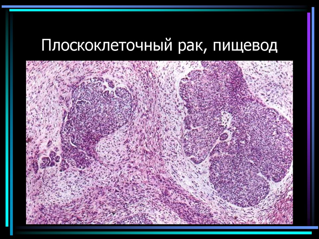 Плоскоклеточный рак, пищевод