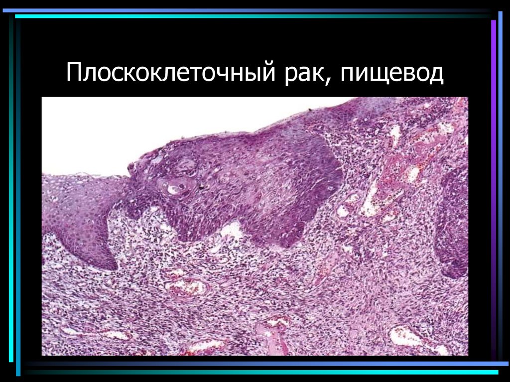 Плоскоклеточный рак, пищевод