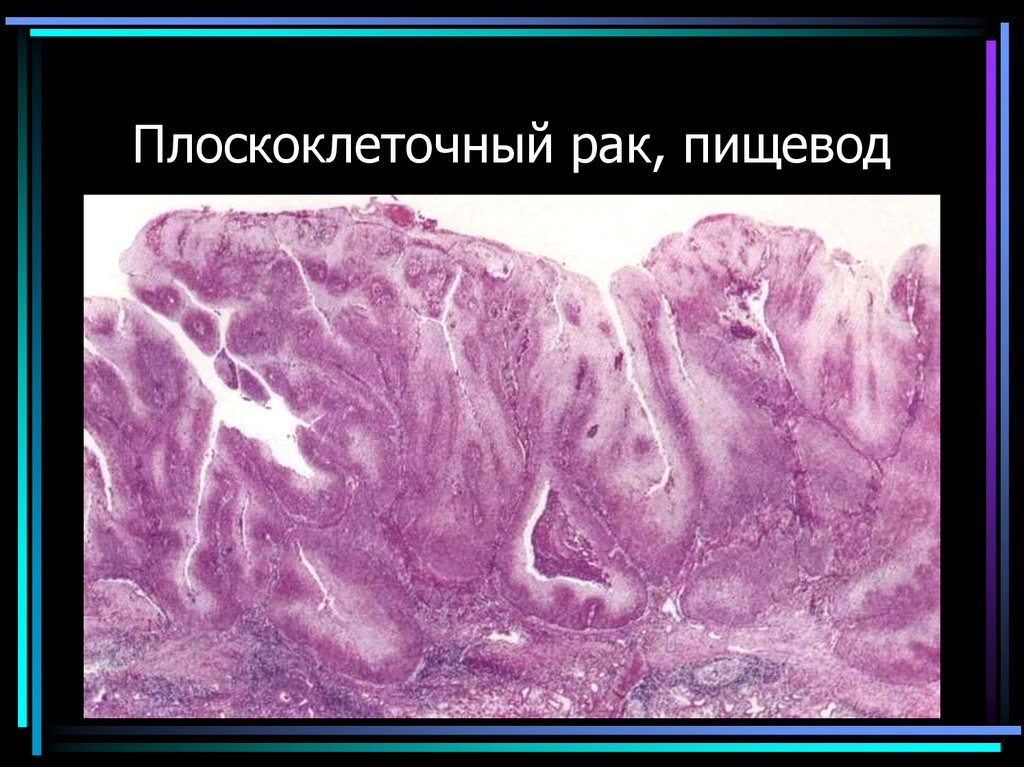 Плоскоклеточный рак, пищевод