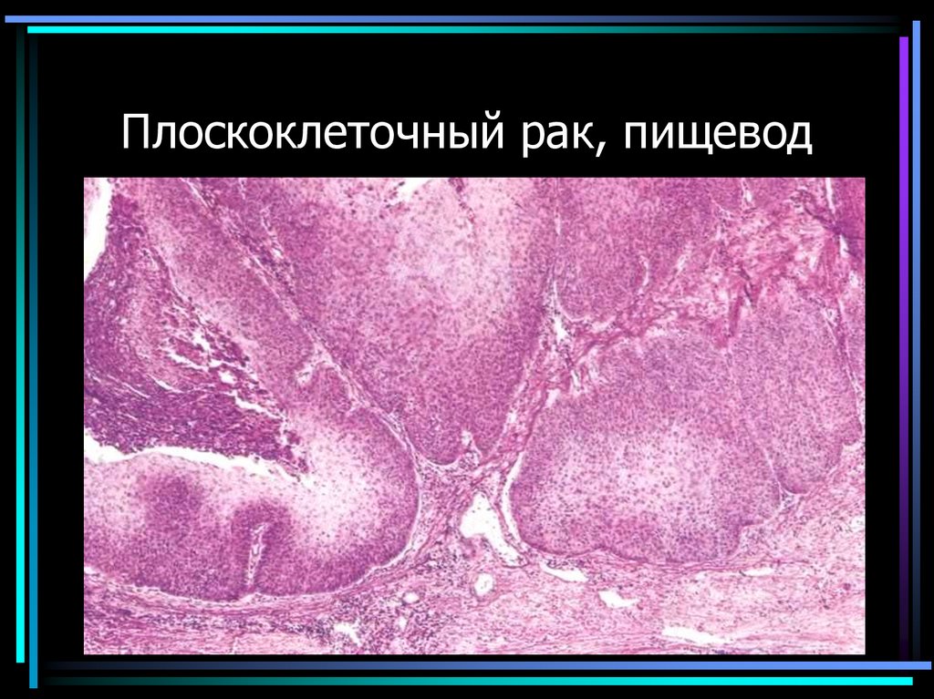 Плоскоклеточный рак, пищевод