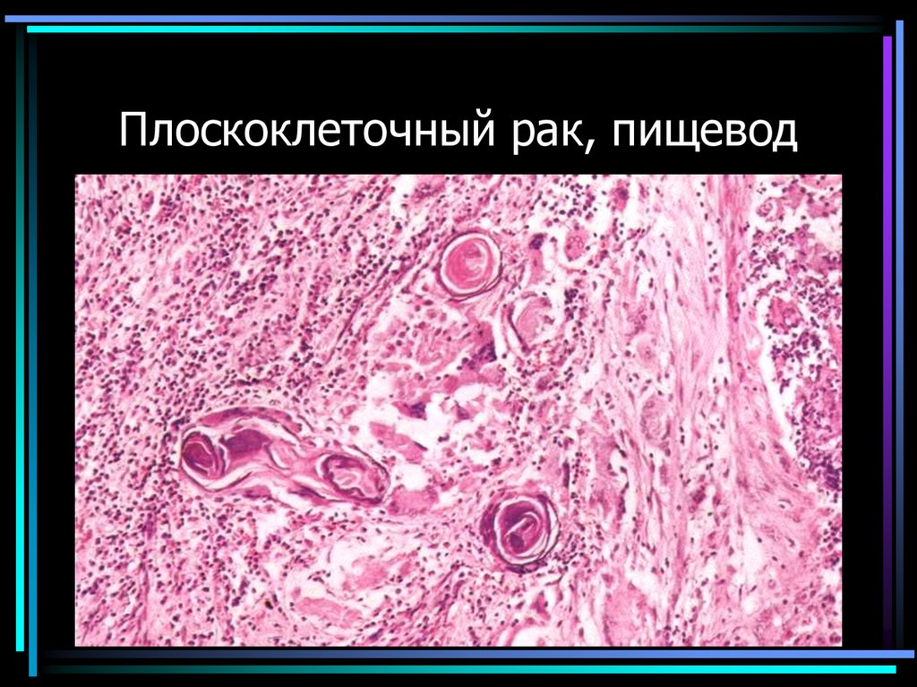 Плоскоклеточный рак, пищевод