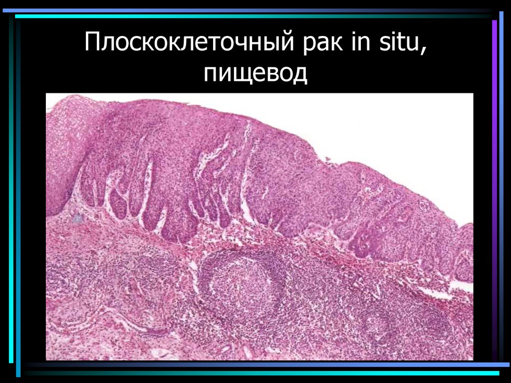 Плоскоклеточный рак in situ, пищевод