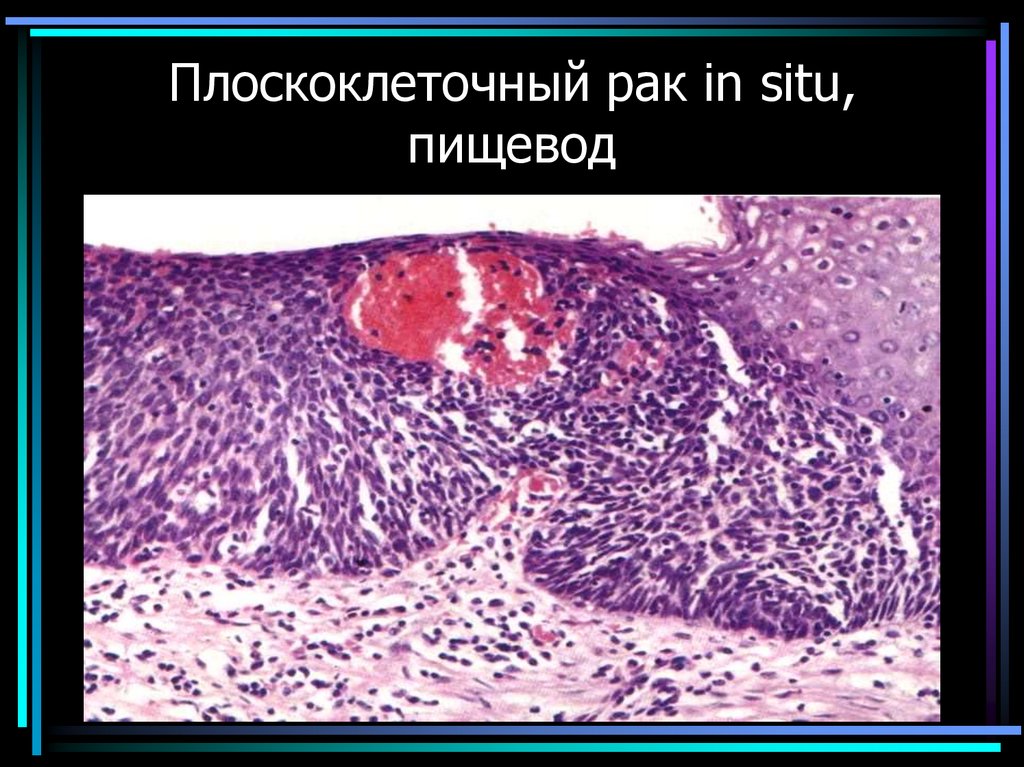 Плоскоклеточный рак in situ, пищевод