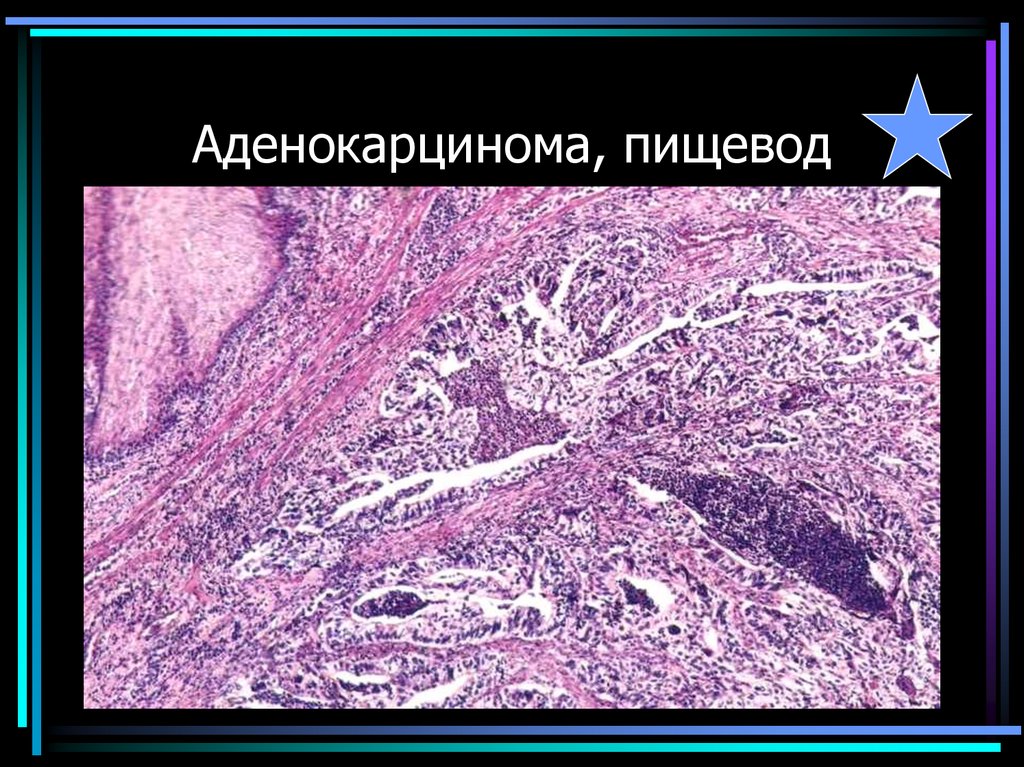 Аденокарцинома, пищевод