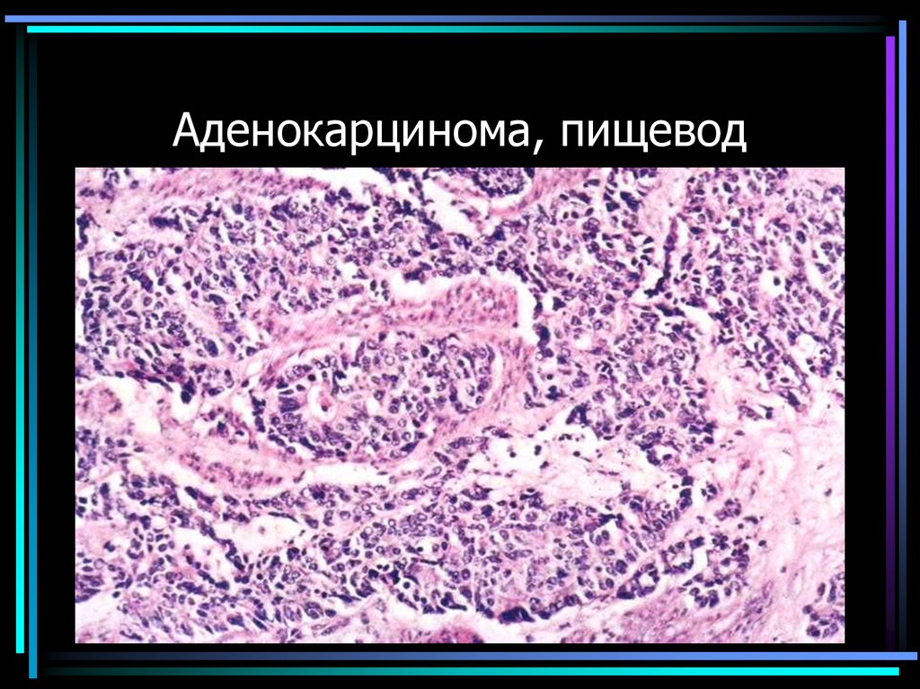 Аденокарцинома, пищевод