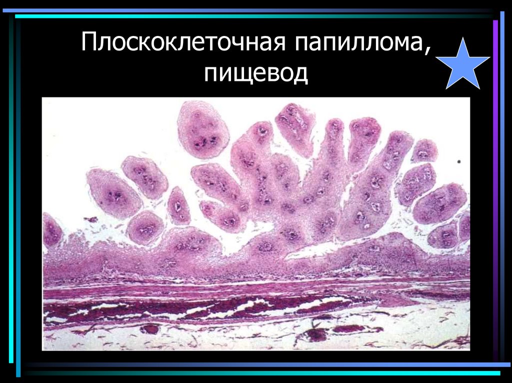 Плоскоклеточная папиллома, пищевод