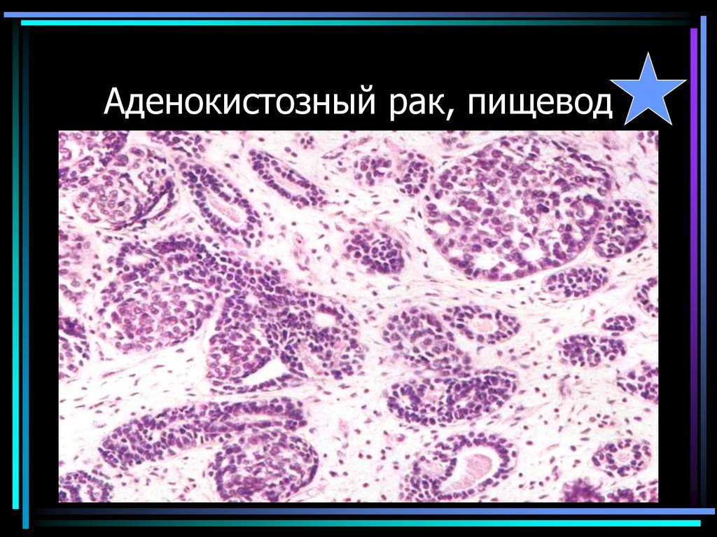 Аденокистозный рак, пищевод