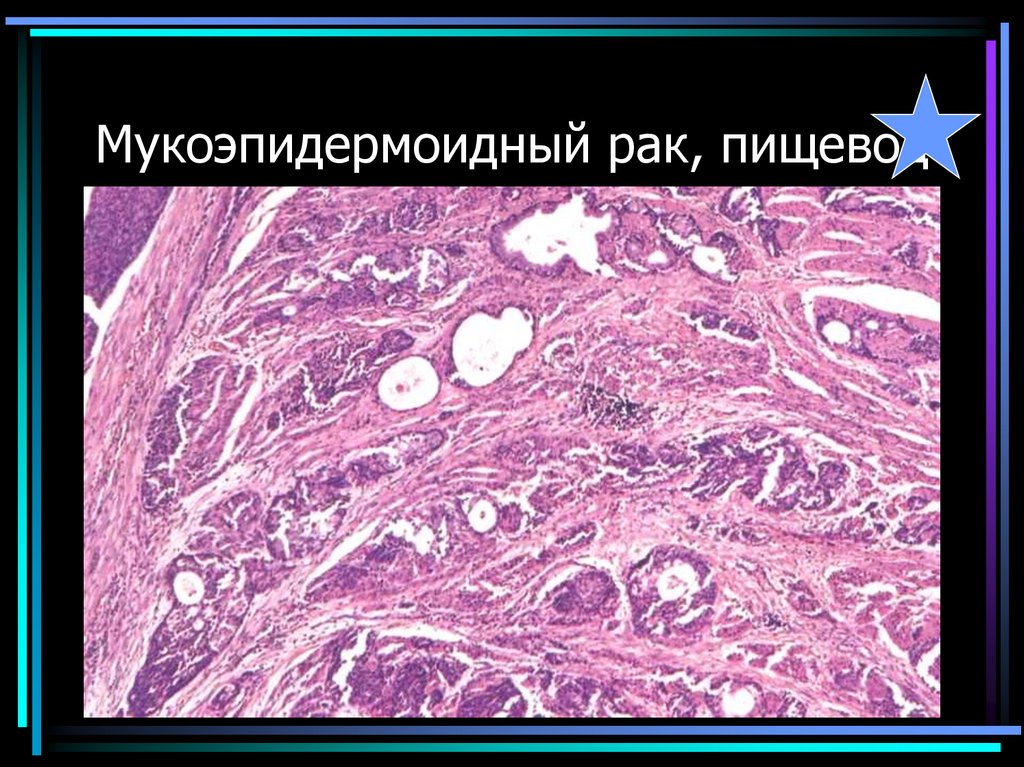 Мукоэпидермоидный рак, пищевод